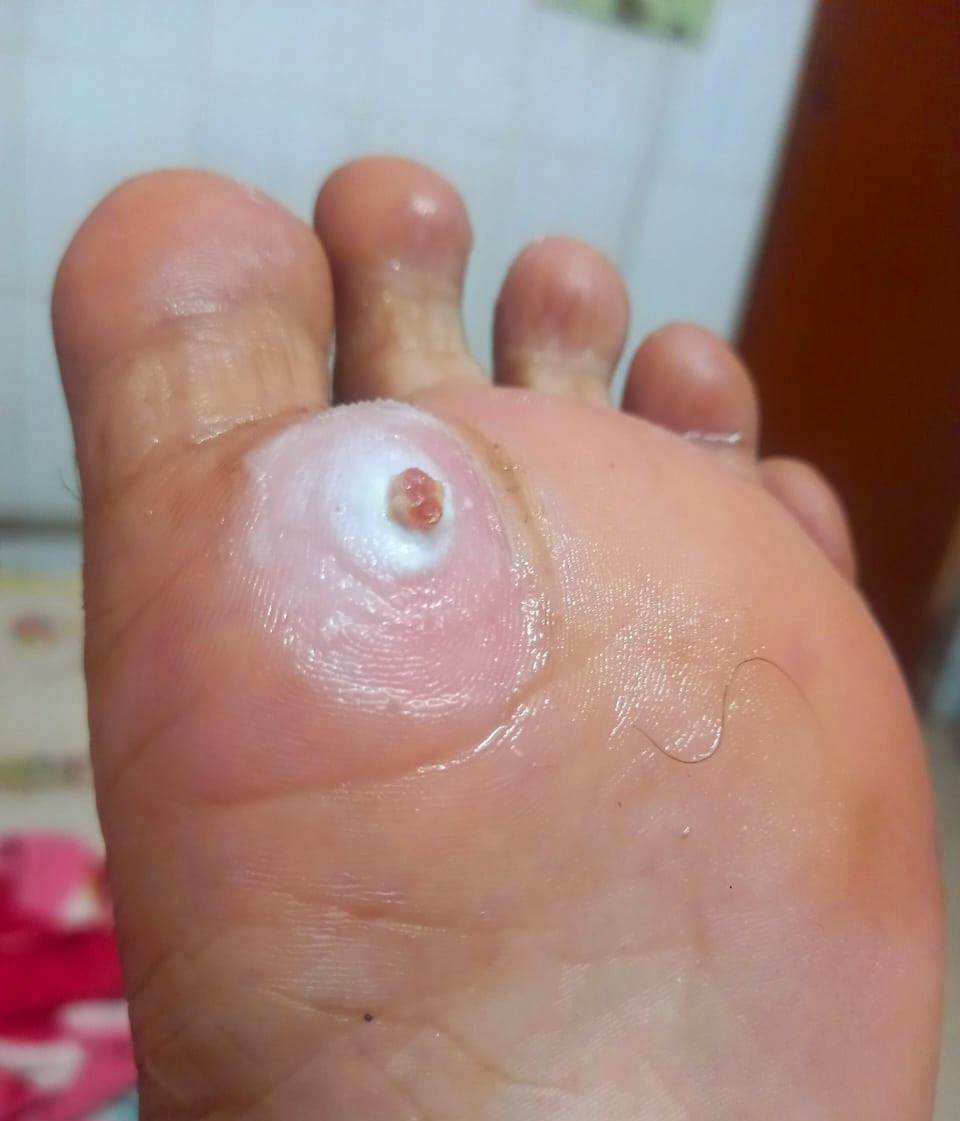 Foot Corn Removal Gel