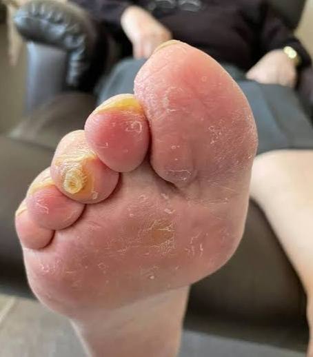 Foot Corn Removal Gel