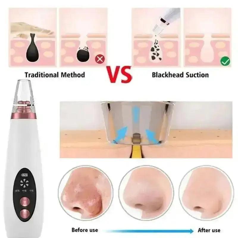 Rechargeable Blackheads Remover Machine