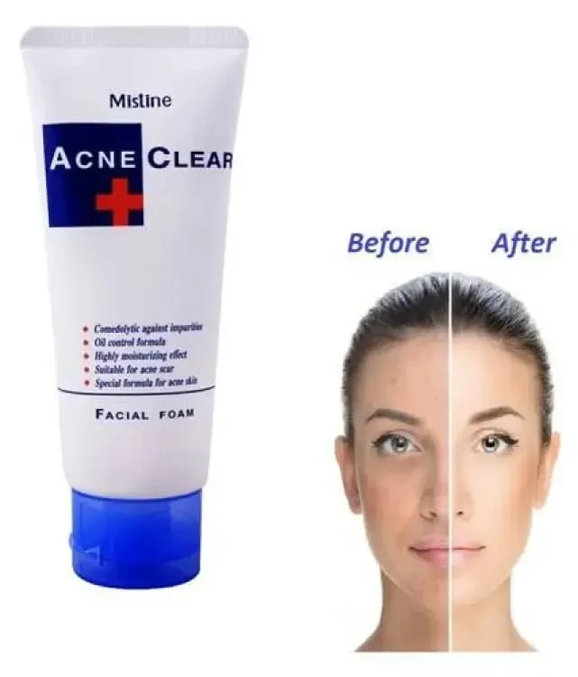 Mistine Acne Clear Facial Foam Face Wash - 85Gm | Made In Thailand