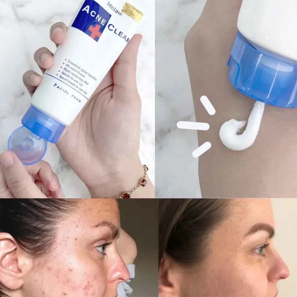 Mistine Acne Clear Facial Foam Face Wash - 85Gm | Made In Thailand